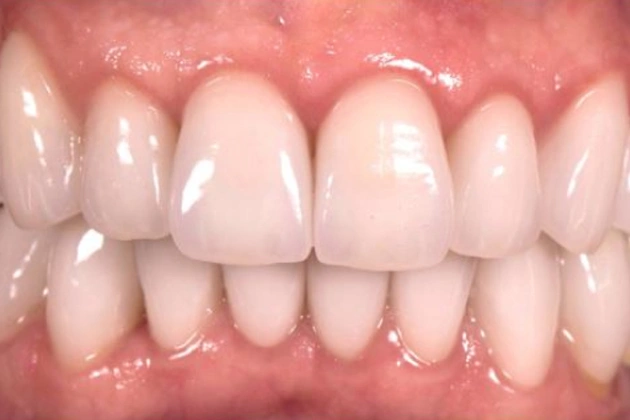 Close-up view of healthy, well-aligned upper and lower teeth displaying proper dental alignment and white tooth color.
