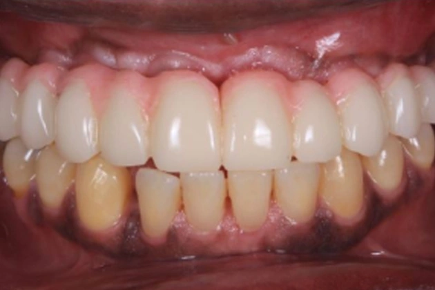 Close-up of human teeth and gums showing dental condition and bite alignment in clinical setting.