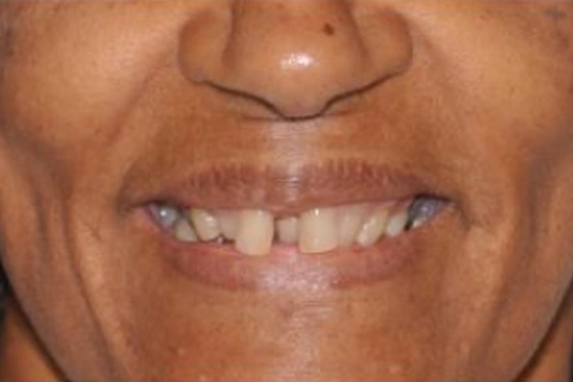 Close-up of person's smile showing dental work and tooth alignment treatment results.