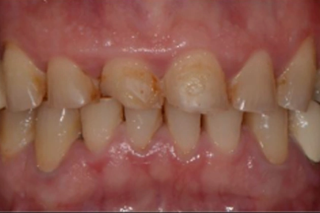 Close-up view of upper front teeth showing discoloration and wear, dental examination setting.