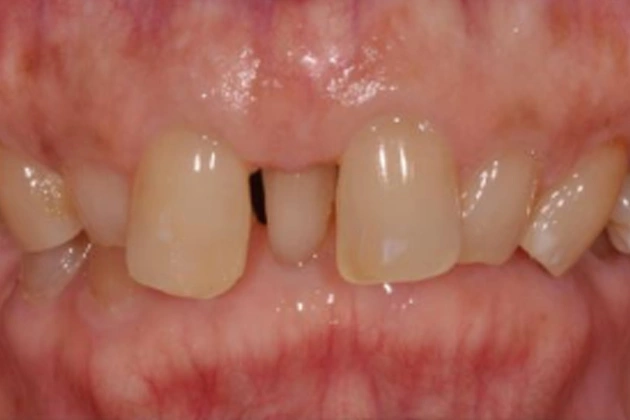 Upper front teeth with gap between central incisors, dental specialty clinical photograph.