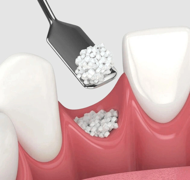 Dental bone graft material being placed on gum tissue during implant procedure.