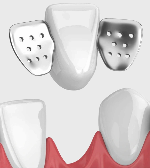 Dental implant components displayed above a tooth model showing placement in gum tissue.