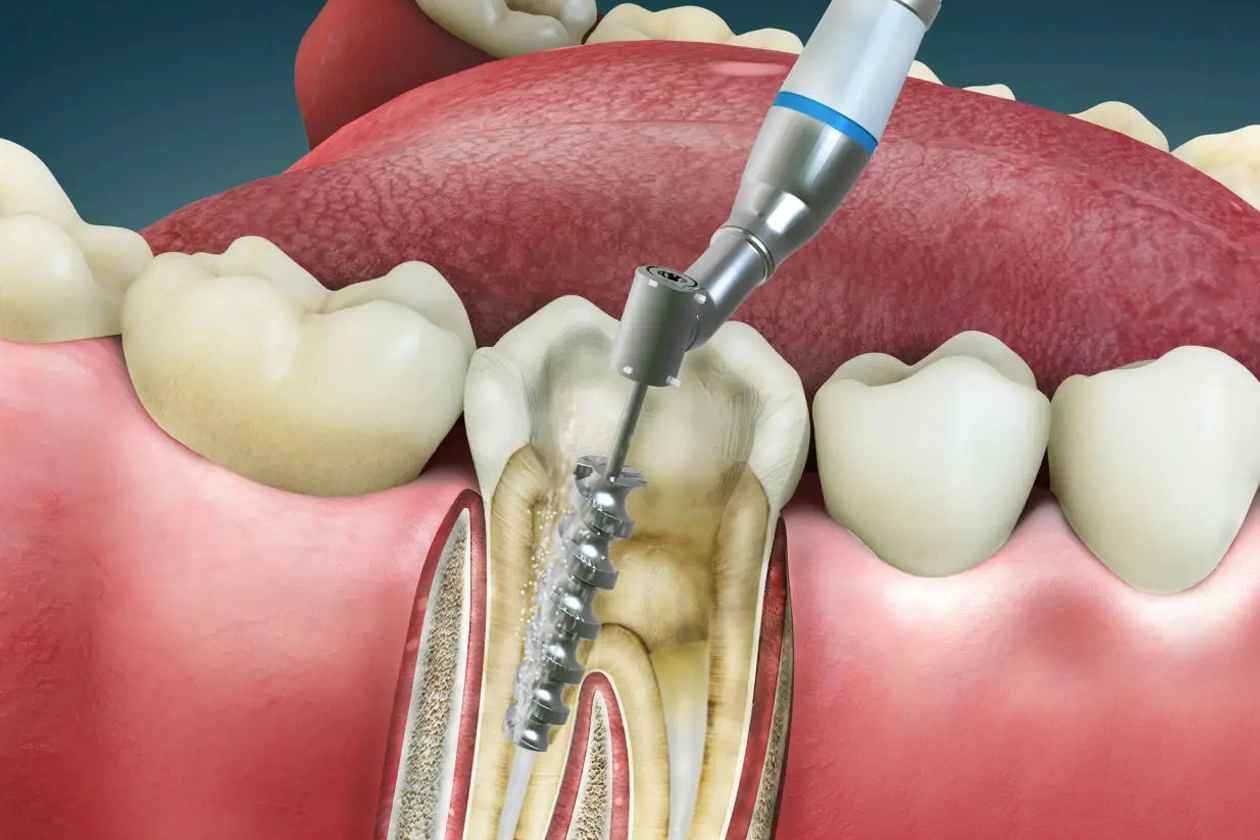 Dental implant procedure illustration showing surgical placement of titanium screw into jawbone with surrounding teeth and gum tissue.