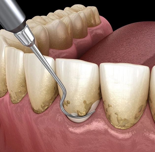 Dental scaling tool removing tartar buildup from tooth surface during professional cleaning procedure.
