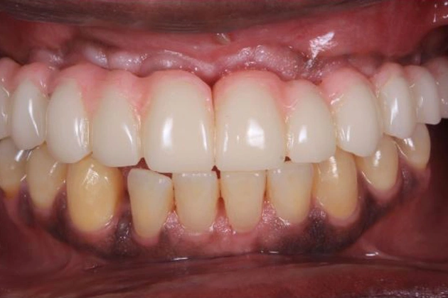 Close-up view of upper and lower teeth showing gum recession and tooth discoloration in dental setting.