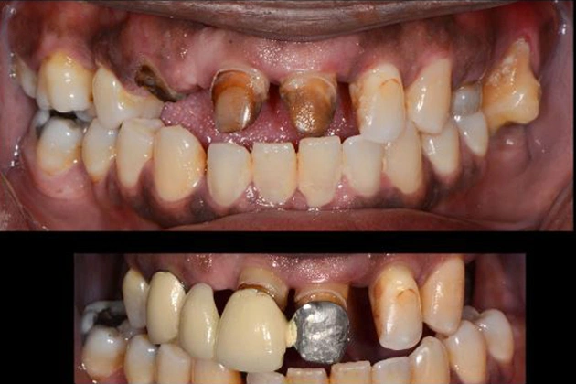 Before and after dental treatment showing tooth restoration and improvement at Maryland Dental Specialty Group.